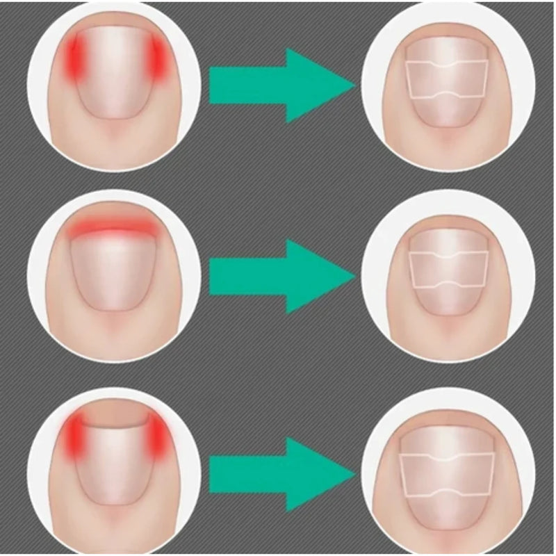 Adesivo Corretor De Unha Encravada